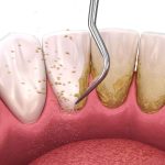 Cara Hilangkan Plak Gigi Secara Alami dan Efektif: Senyum Sehat Tanpa ke Dokter